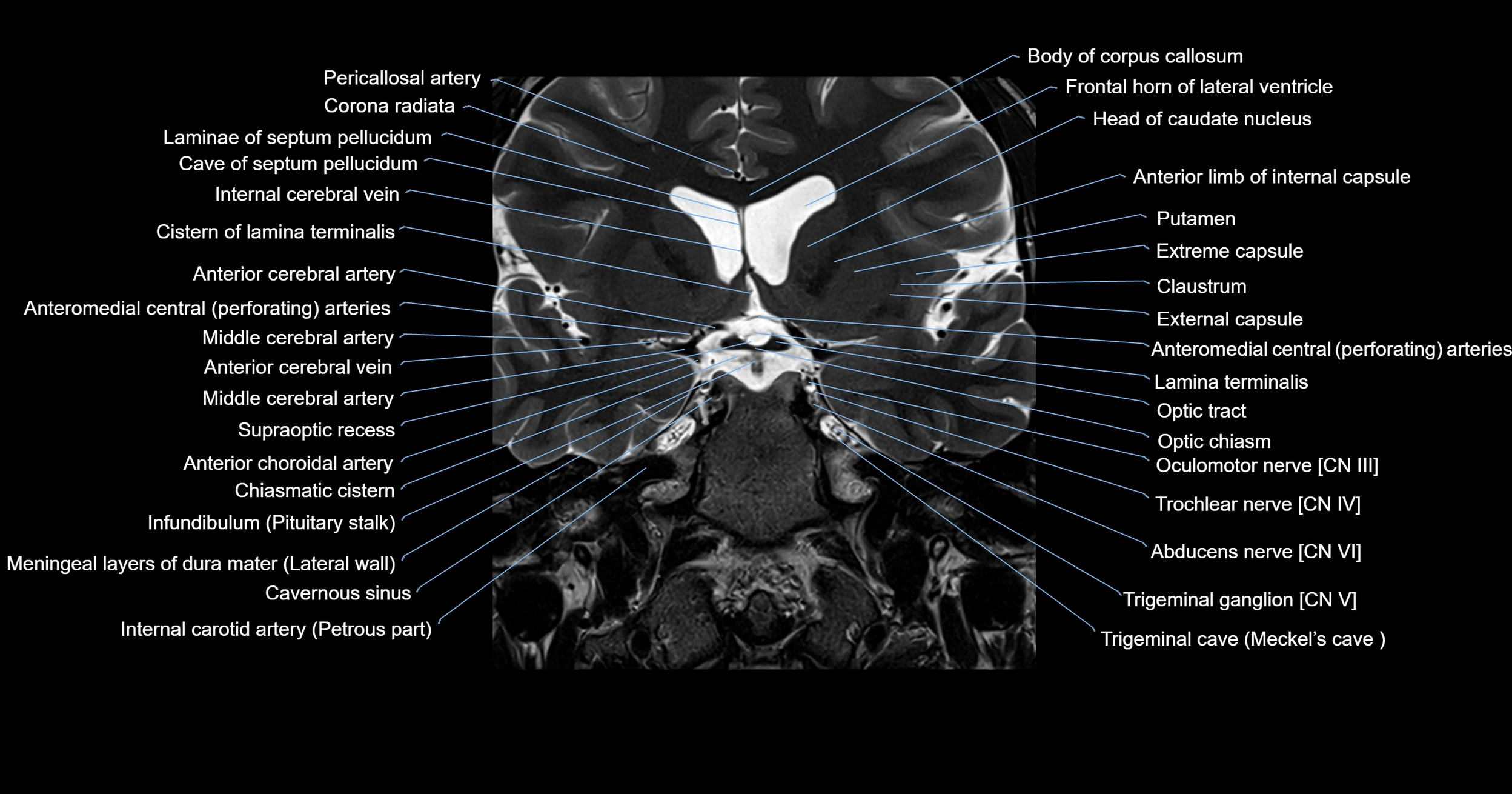 MRI brainstem & basal ganglia anatomy labelled 3T MRI images -img-00001-00013.webp